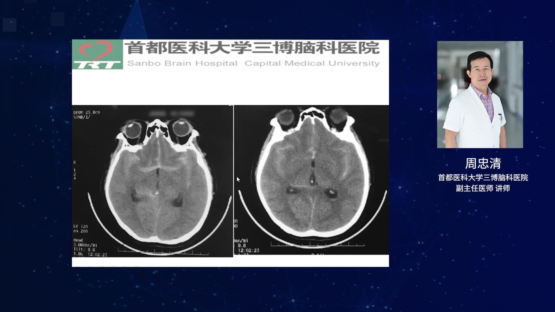 动脉瘤的外科治疗（下）