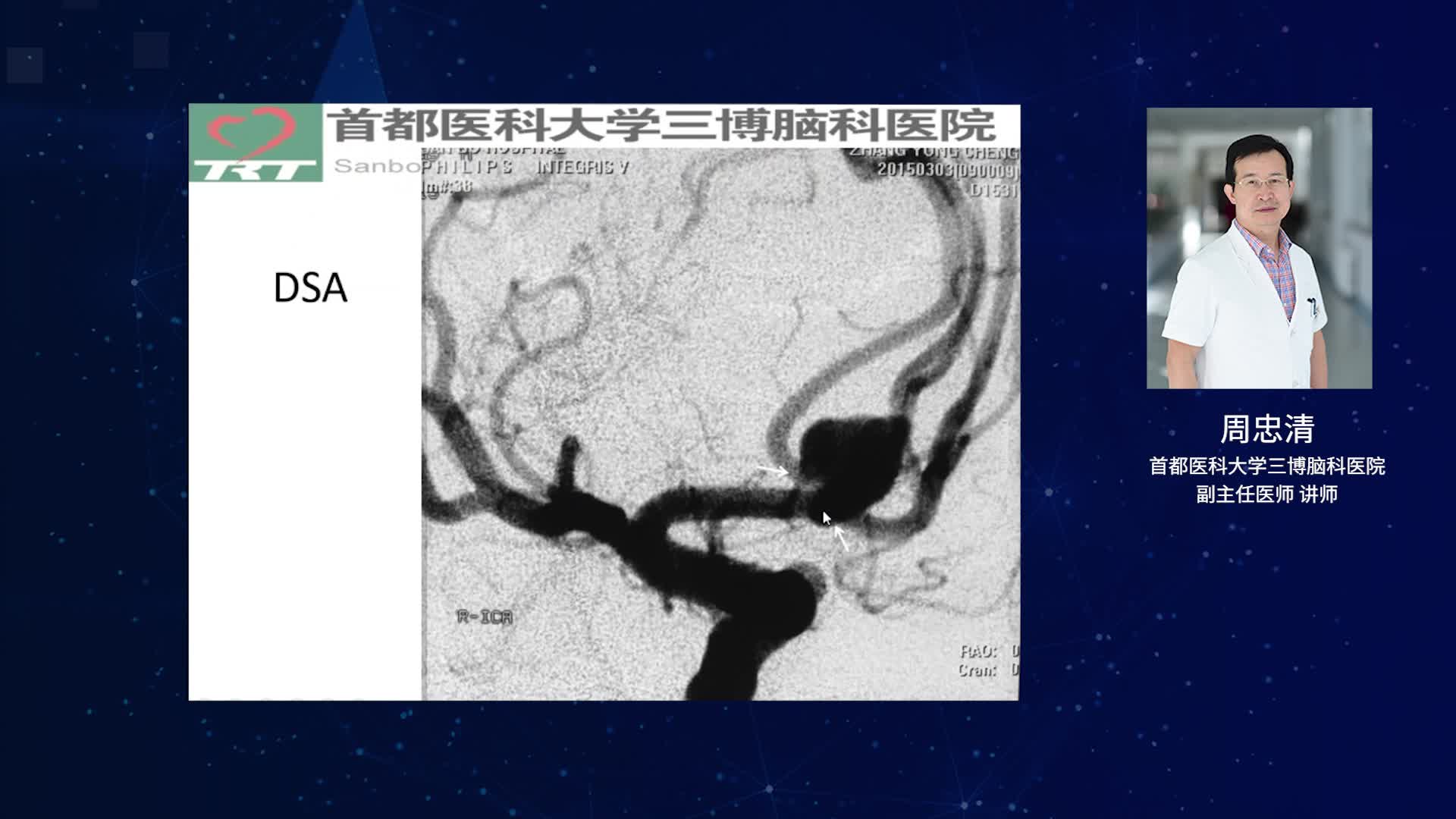 动脉瘤的外科治疗（中）