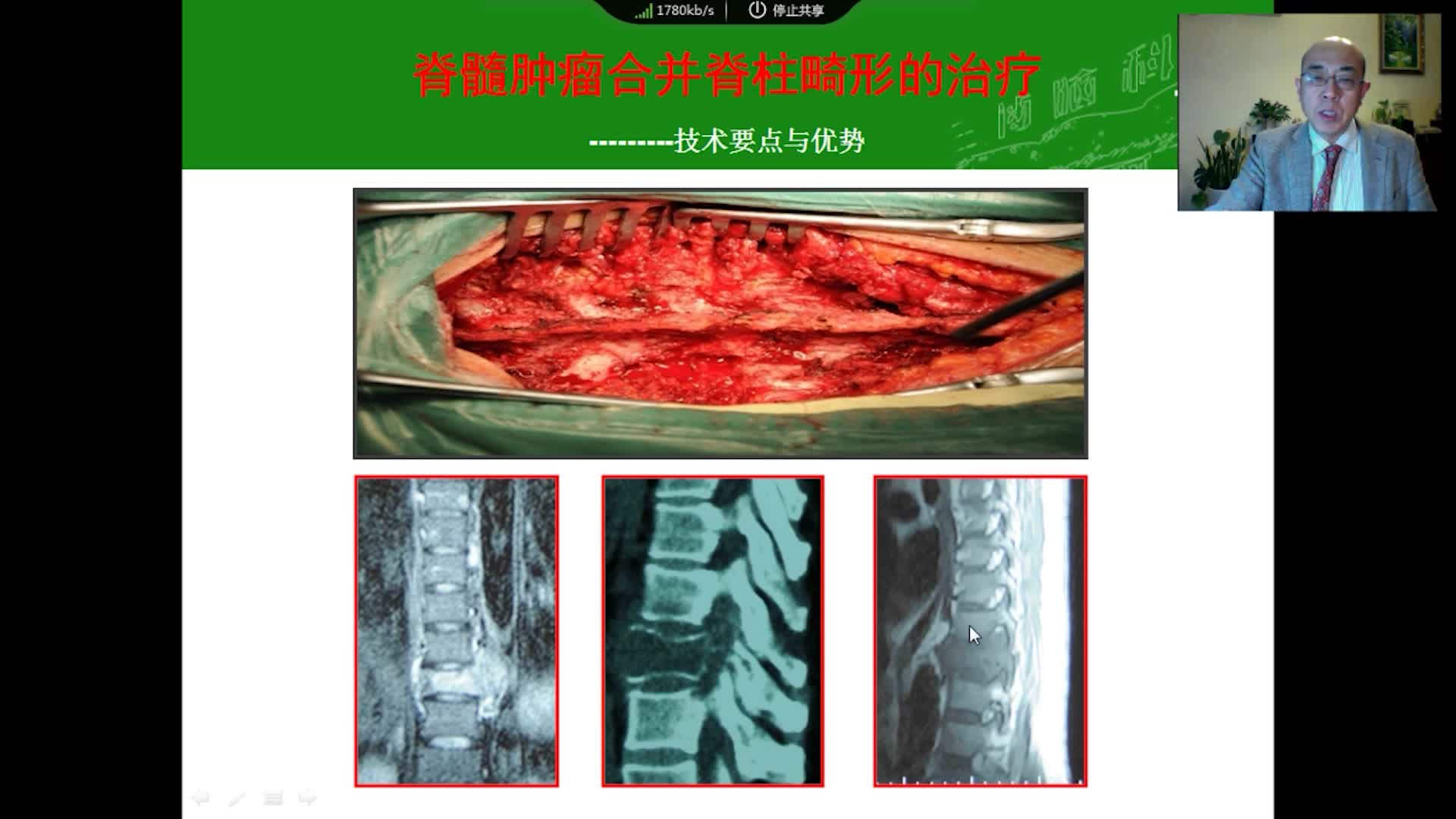 脊髓脊柱肿瘤合并脊柱畸形的治疗技术要点与优势（在线答疑）