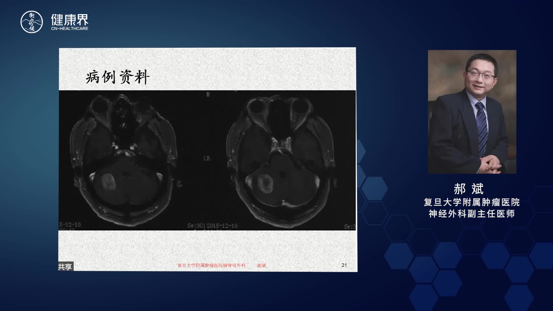 脑转移瘤的外科干预（下）