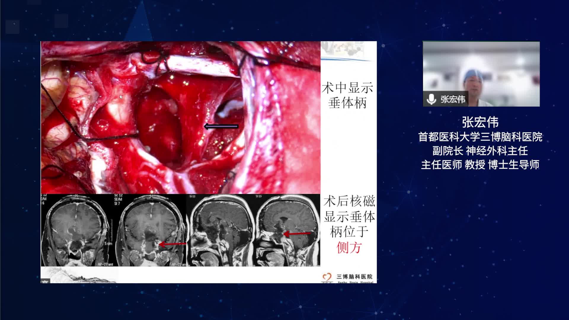 手术治疗三脑室后部肿瘤远期疗效分析（下）